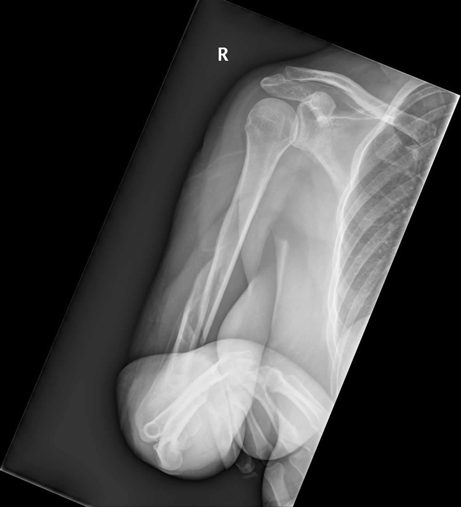 oblique humerus fracture