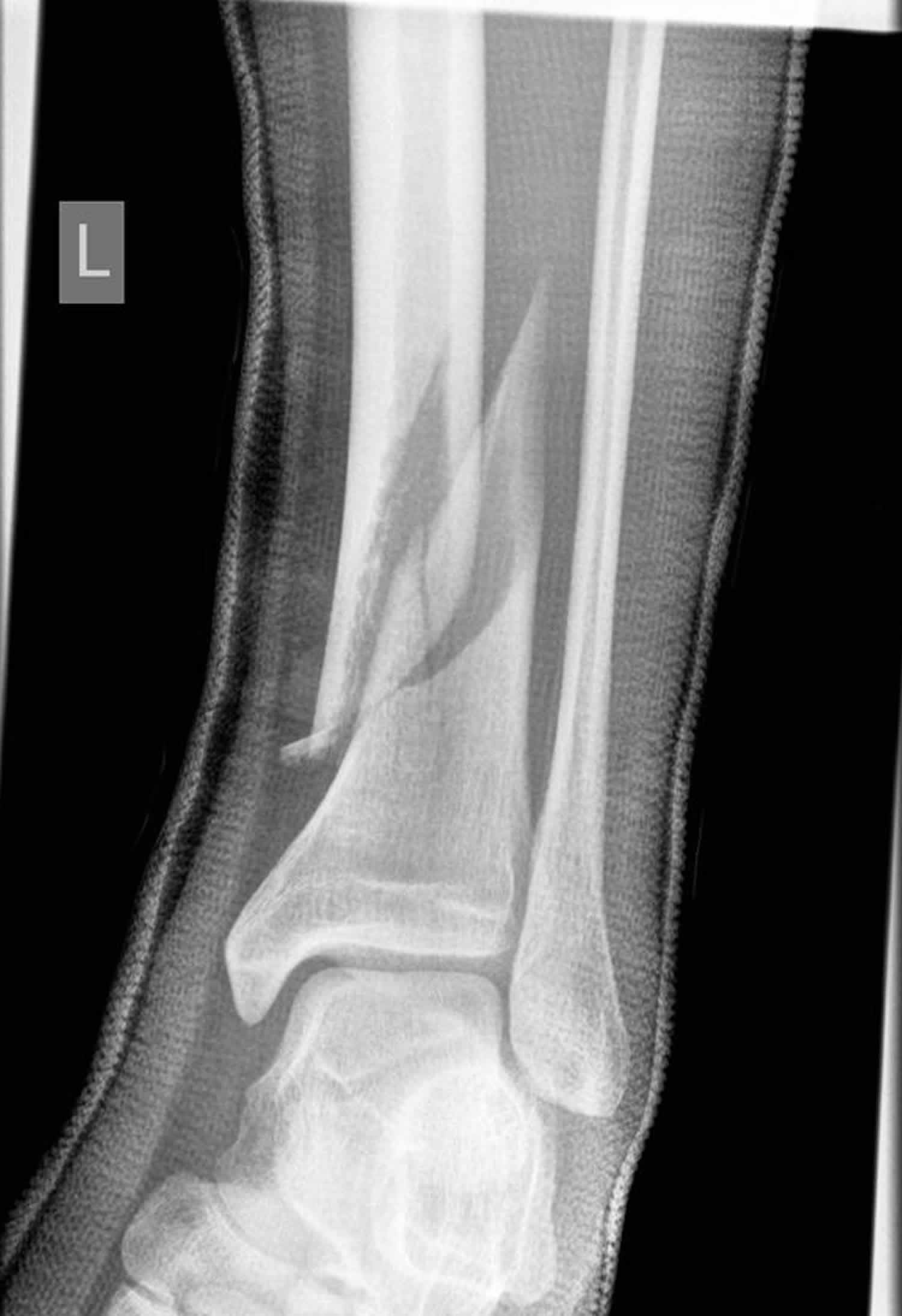 tibial spiral fracture in children