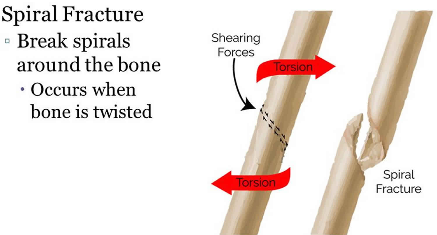 treatment of a spiral fracture