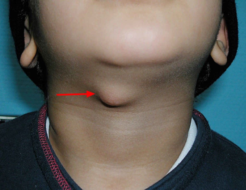 Thyroglossal Duct Cyst Causes Symptoms Diagnosis Treatment And Surgery 