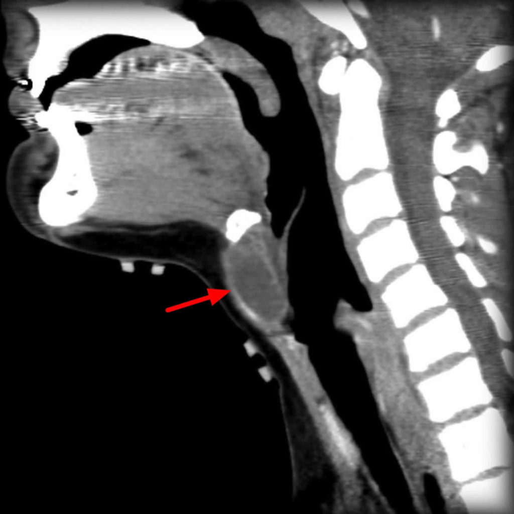 Thyroglossal Duct Cyst Causes Symptoms Diagnosis Treatment And Surgery