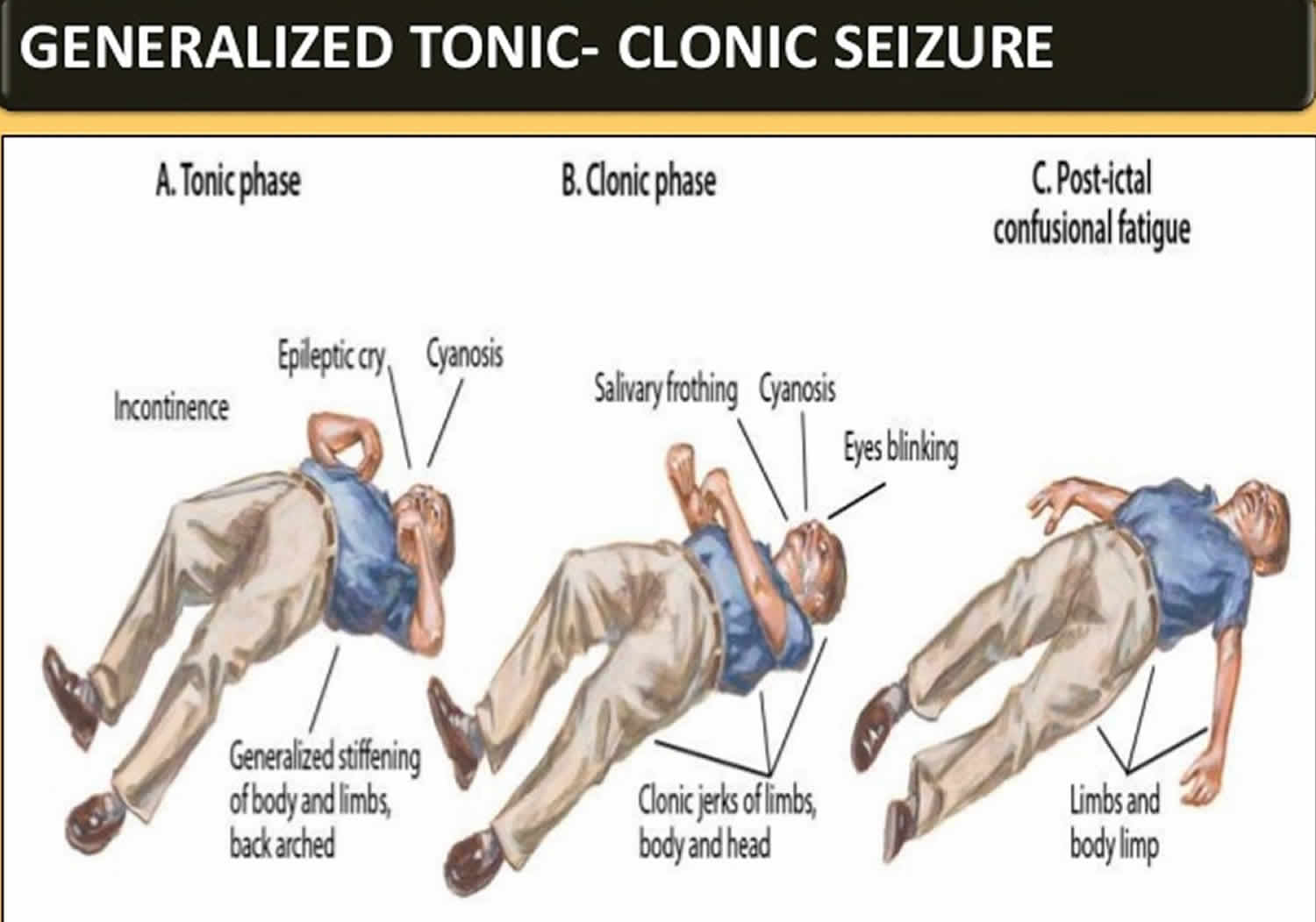 Tonic clonic seizure definition, first aid, causes, symptoms & treatment