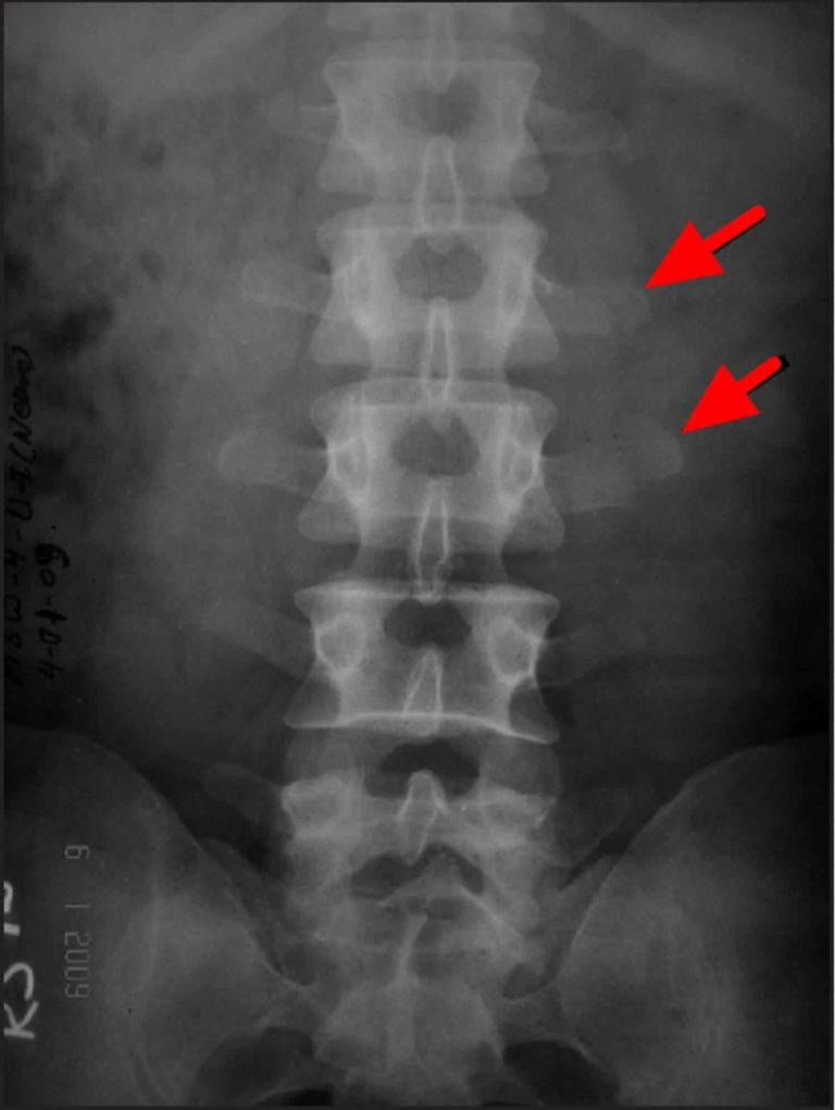 L3 Transverse Process Fracture