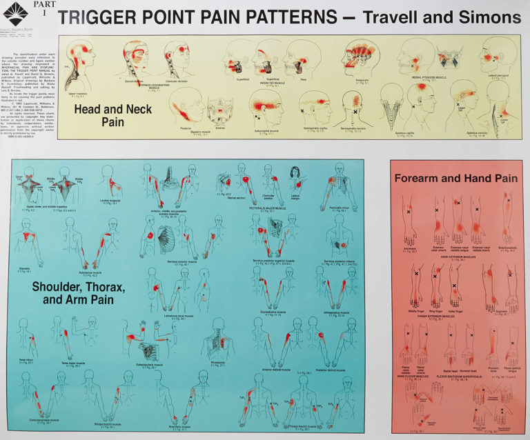 Myofascial trigger points definition signs symptoms diagnosis therapy