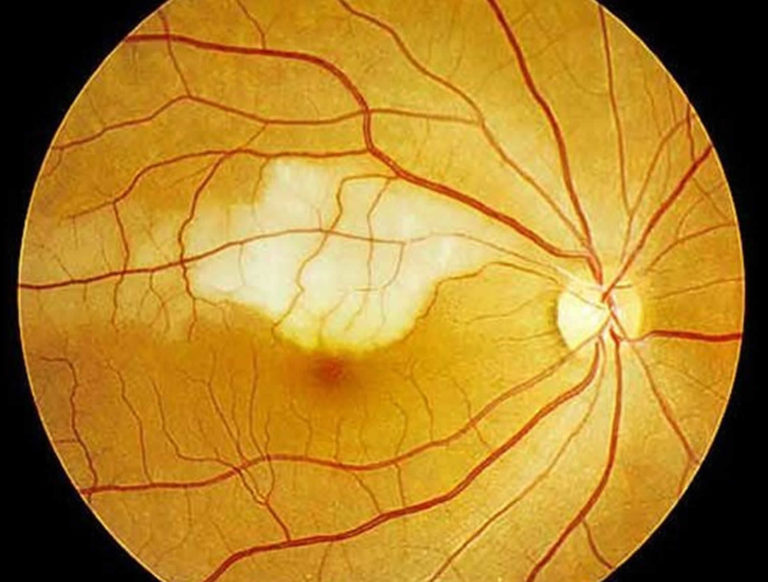 Central Retinal Artery Occlusion Treatment Prevention - Vrogue.co