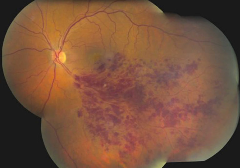 Vitreous hemorrhage causes, symptoms, diagnosis, treatment & prognosis