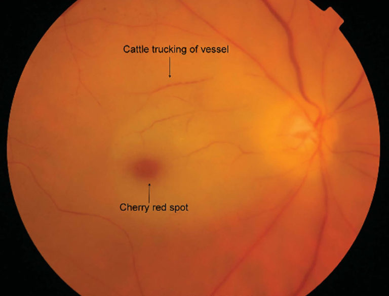 Retinal artery occlusion causes, symptoms, diagnosis, treatment & prognosis