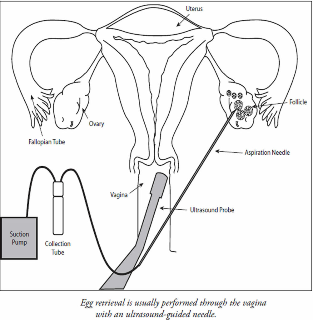 Zift or zygote intrafallopian transfer procedure for infertility