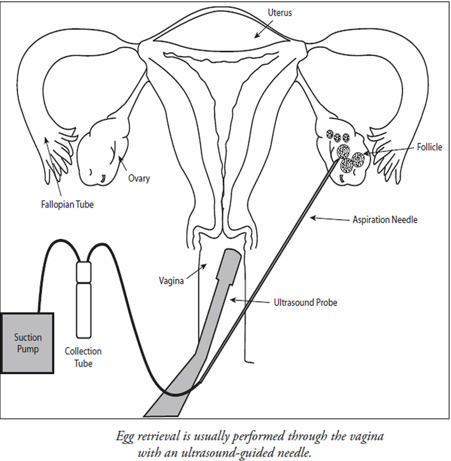 PDF) Routine Gamete Intrafallopian Transfer (GIFT): A Highly Successful  Option for Treatment of Non-Tubal Infertility | Milton Leong - Academia.edu