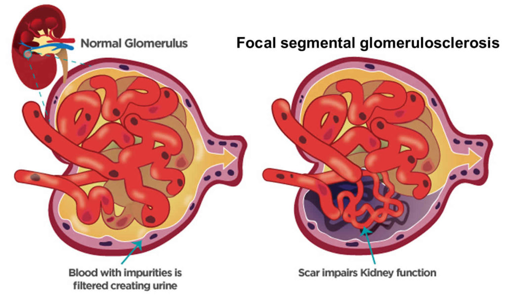 Focal Segmental Glomerulosclerosis Causes, Symptoms, Diagnosis & Treatment