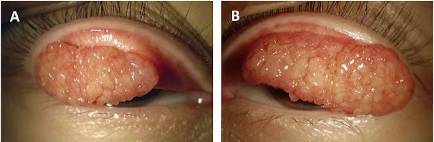 giant papillary conjunctivitis treatment