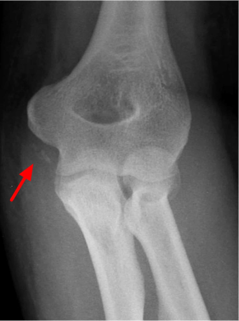 Heterotopic Ossification Causes Prevention Symptoms Diagnosis