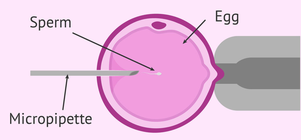 Zift or zygote intrafallopian transfer procedure for infertility