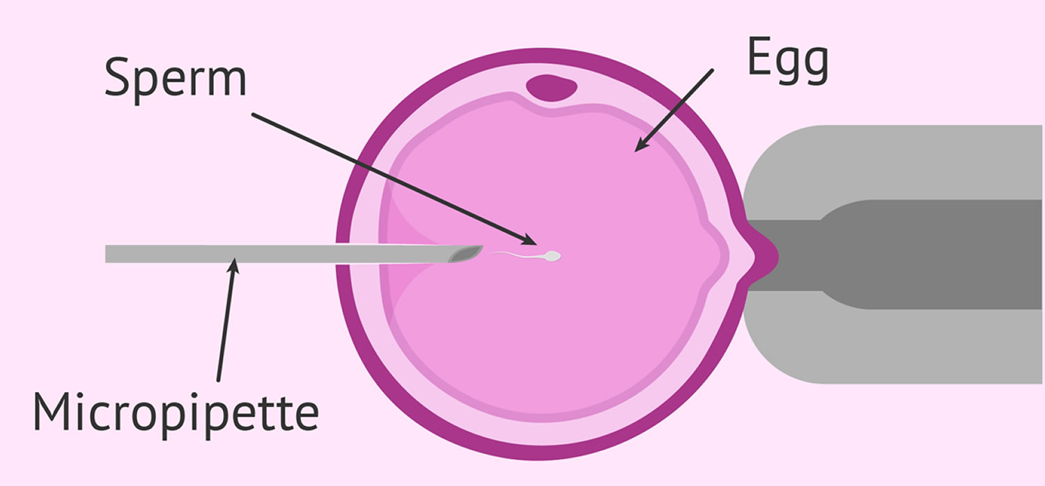 Making Sense of IVF Statistics | RSC Bay Area