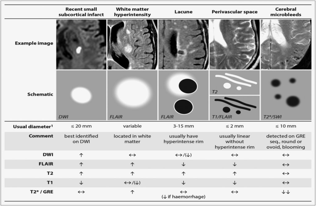 Lacunar Stroke Definition Causes Symptoms Diagnosis Prognosis Treatment