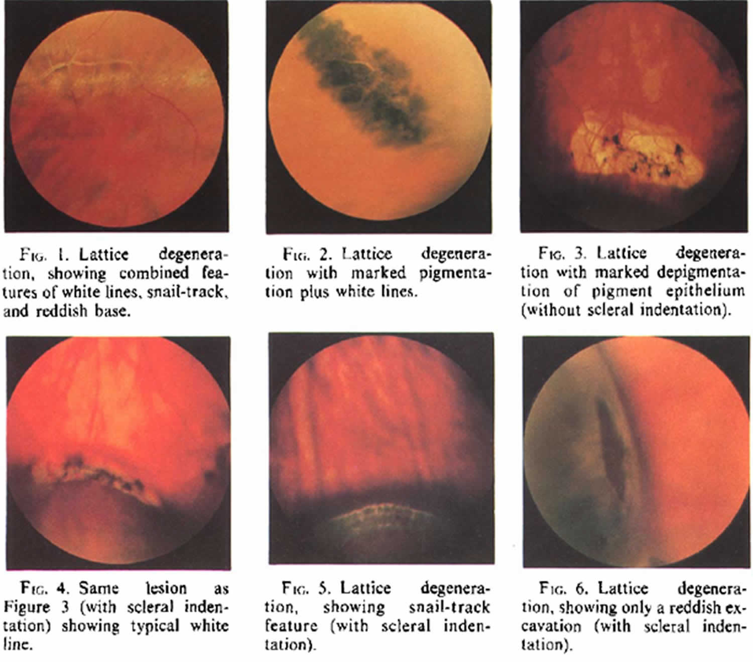retinal lattice degeneration causes