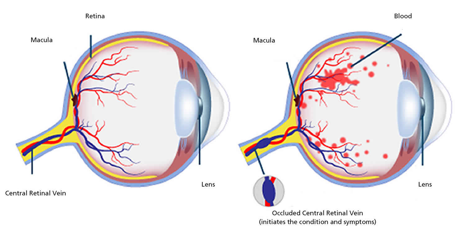 Retinal Vein Occlusion Causes Symptoms Diagnosis Treatment Prognosis