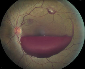 vitreous hemorrhage adjacent