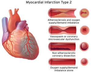 Myocardial infarction definition, causes, signs, symptoms, diagnosis ...