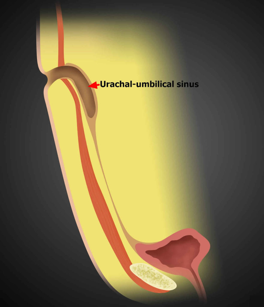 Urachus definition, urachus cyst, patent urachus and urachus cancer