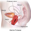 Uterine prolapse