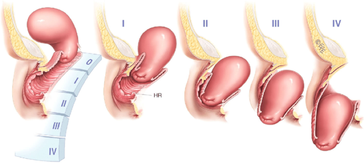 Uterine Prolapse Causes Risk Factors Symptoms Stages And Treatment