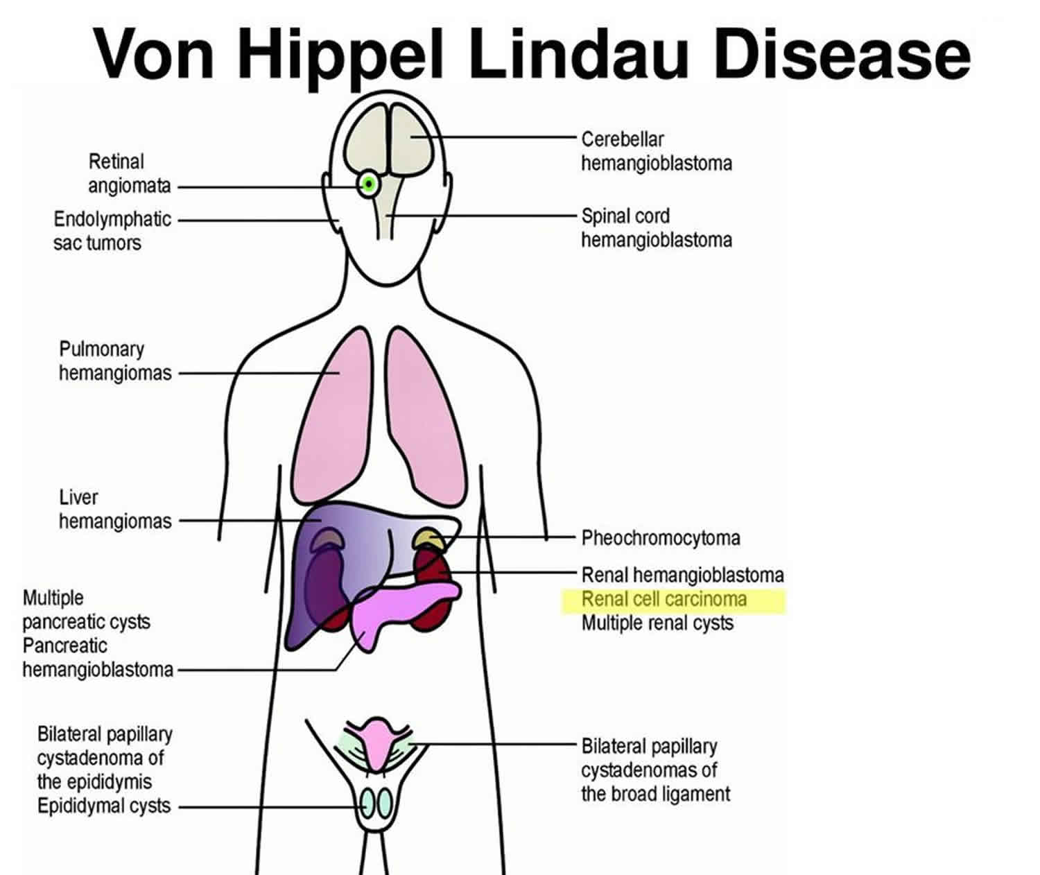 VHL von Hippel Lindau Disease Accessories Bundle 