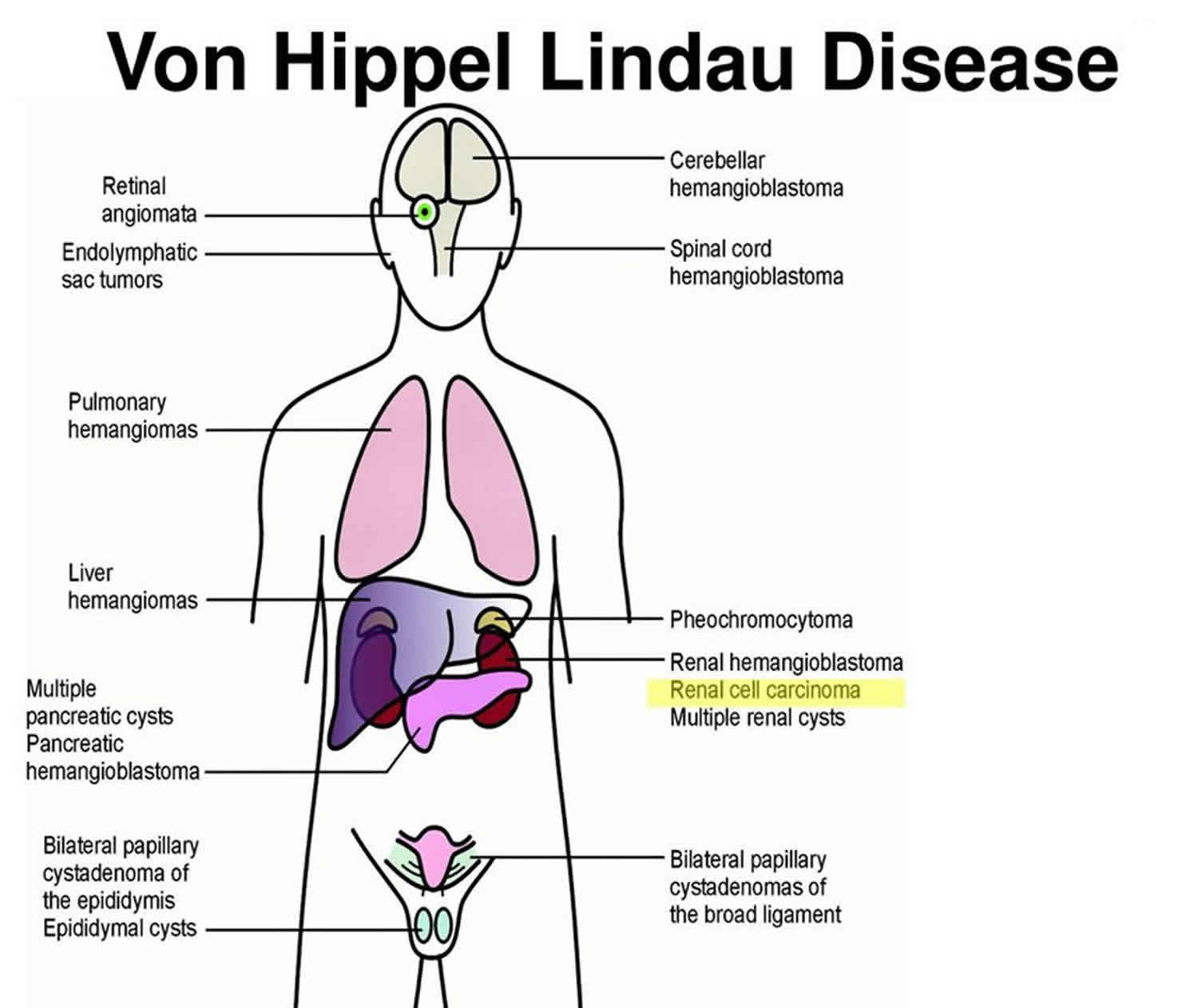 Von hippel lindau usmle