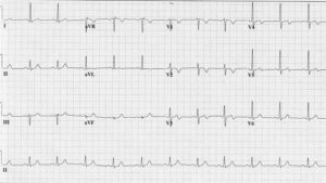 Wellens syndrome definition, diagnostic criteria, causes, symptoms ...