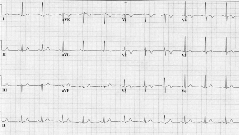 Wellens syndrome definition, diagnostic criteria, causes, symptoms