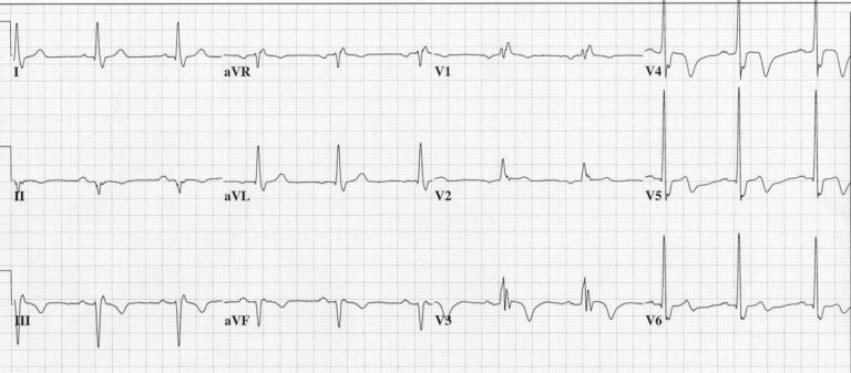 Wellens syndrome definition, diagnostic criteria, causes, symptoms ...