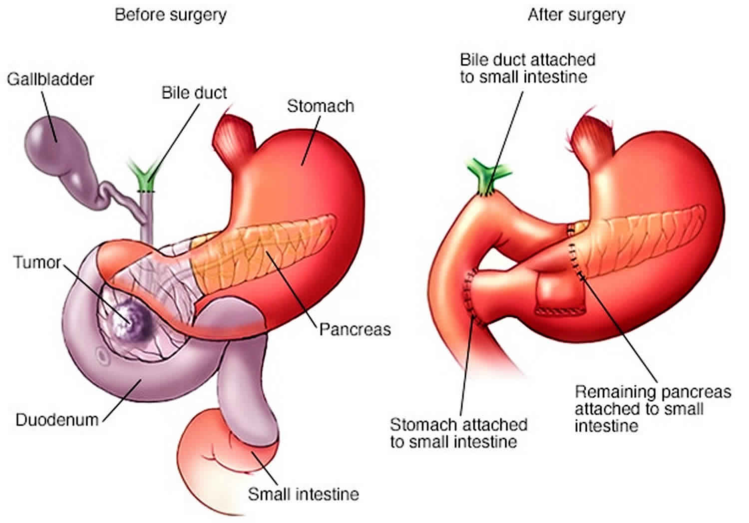 How Long Recovery From Whipple Surgery