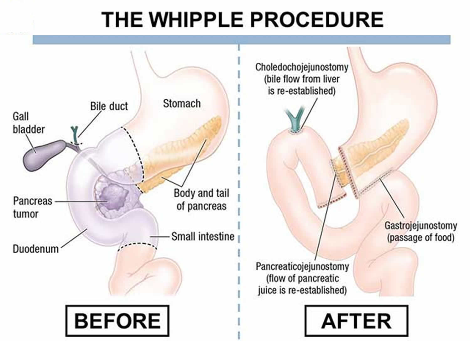 Whipple Procedure Steps Indications Complications Recovery 