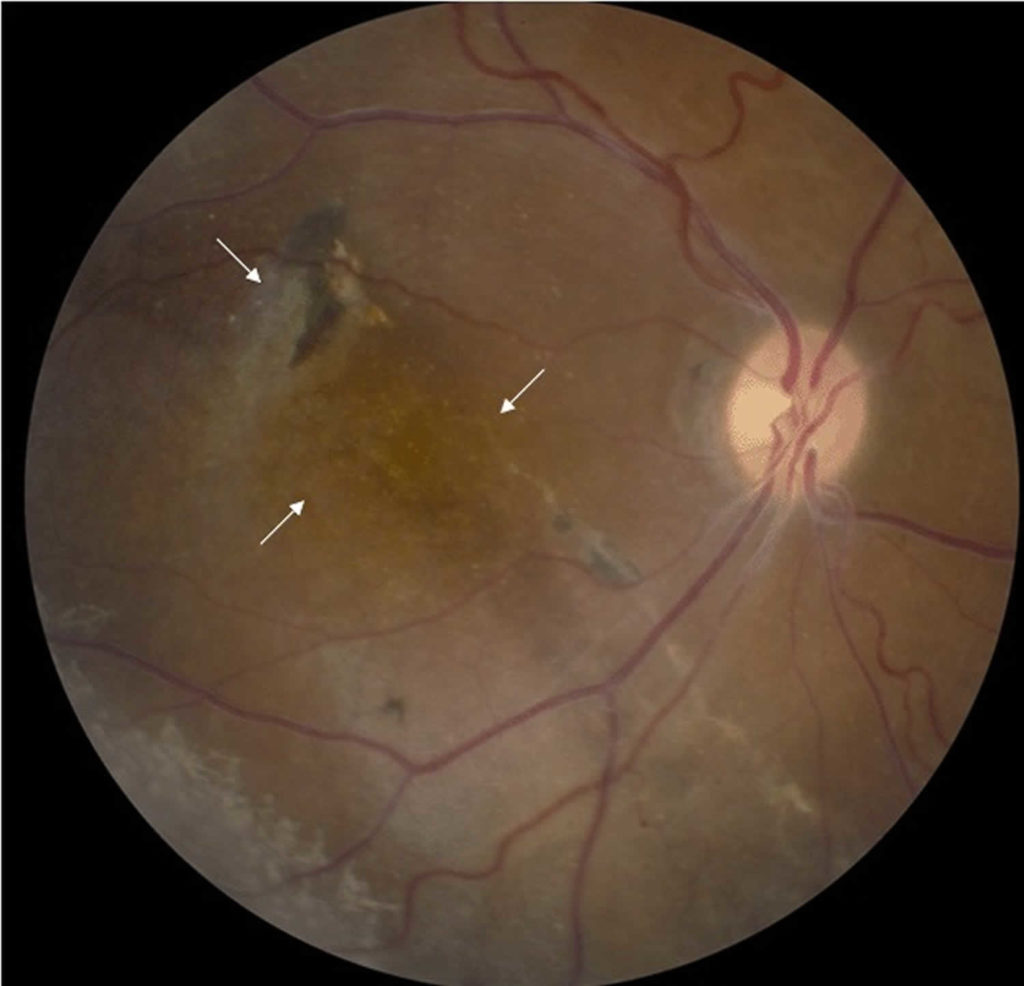 Retinoschisis Causes Symptoms Diagnosis And Retinoschisis Treatment