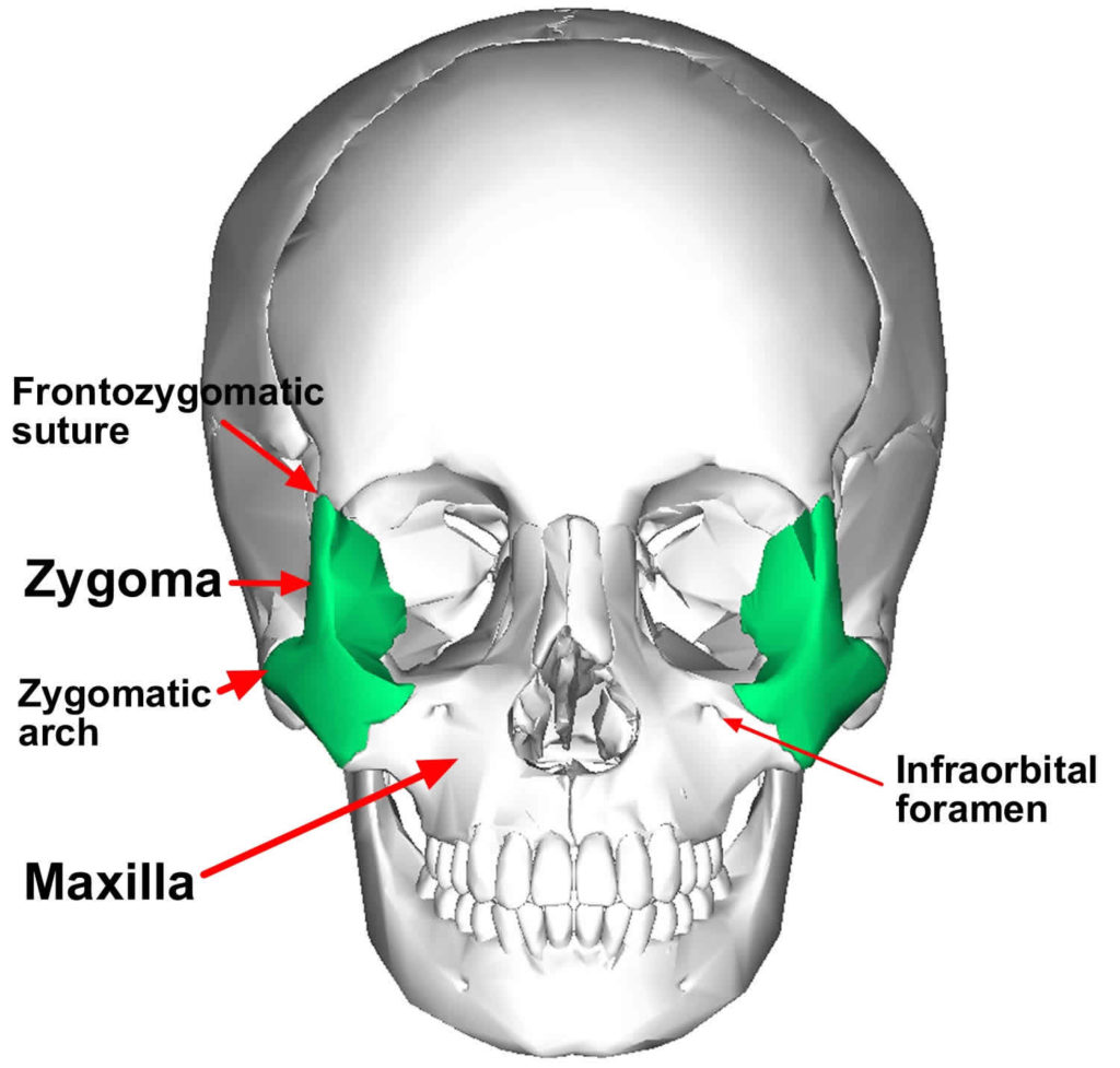 closed fracture of zygomatic arch
