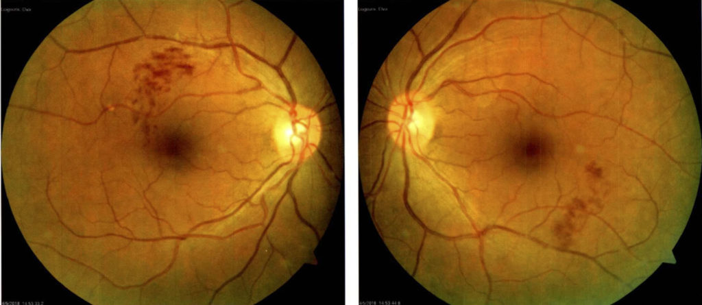 Retinal Vein Occlusion Causes Symptoms Diagnosis Treatment And Prognosis