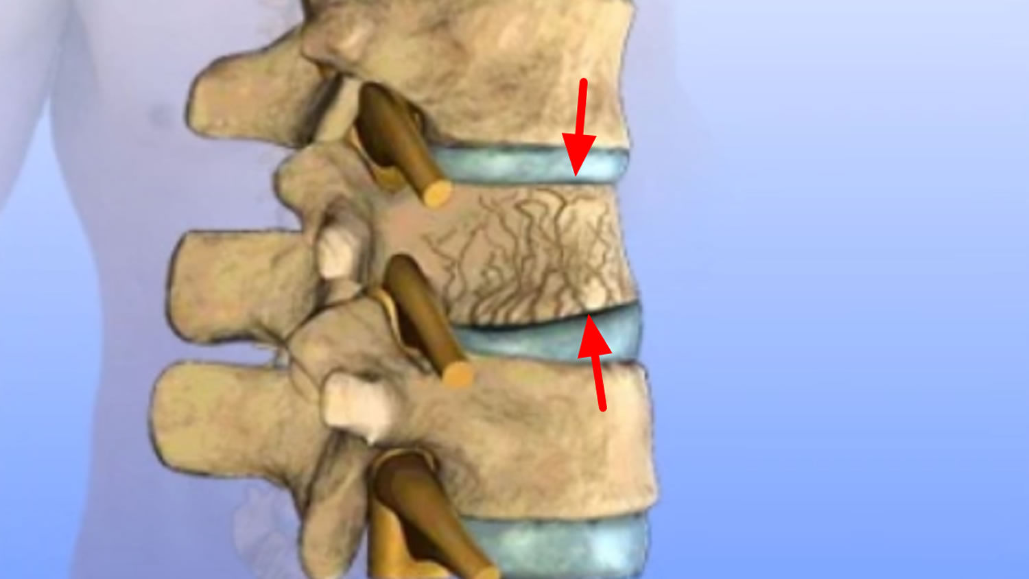 Vertebral Compression Fractures Causes Symptoms And Treatment Bone My Xxx Hot Girl