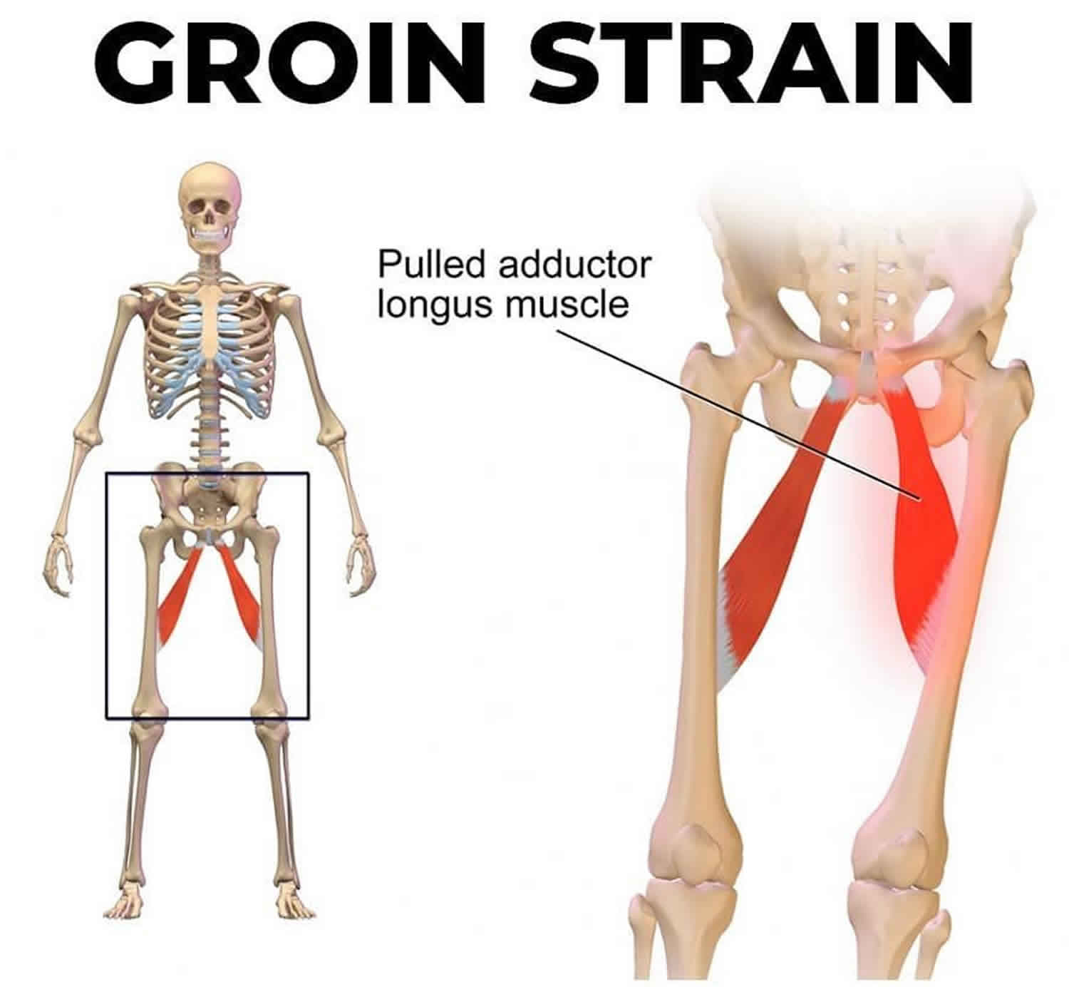 Groin Strain Trauma And Pulled Or Torn Muscle Injury Anatomy Outline 