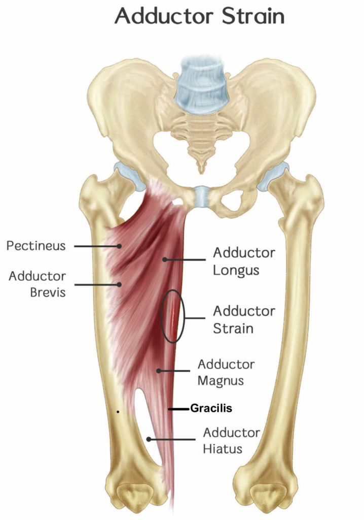 Groin strain causes, symptoms, diagnosis, treatment, exercises ...