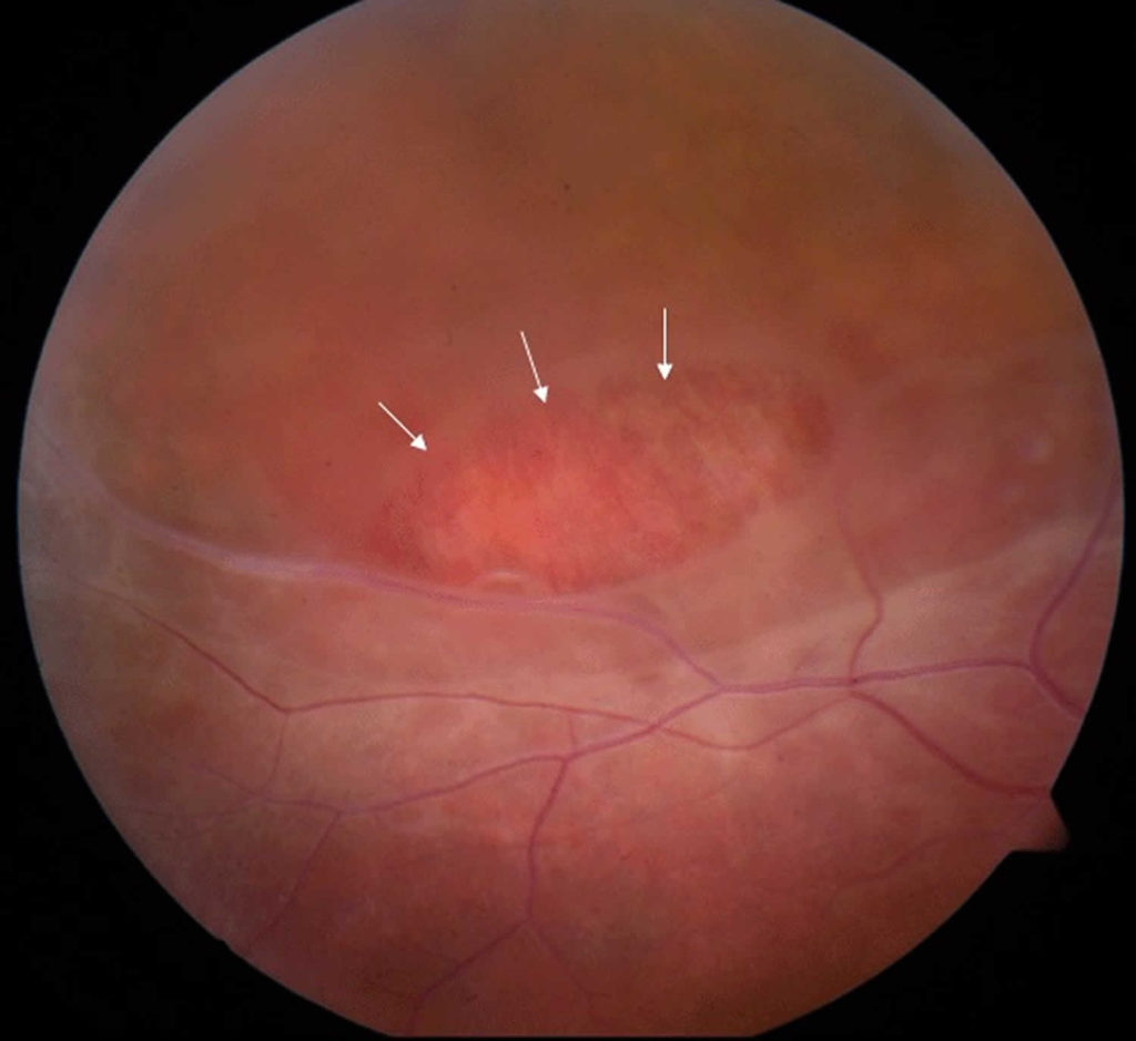 retinal atrophic hole