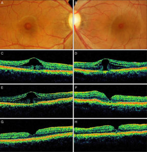 Macular hole causes, symptoms, diagnosis, treatment & prognosis