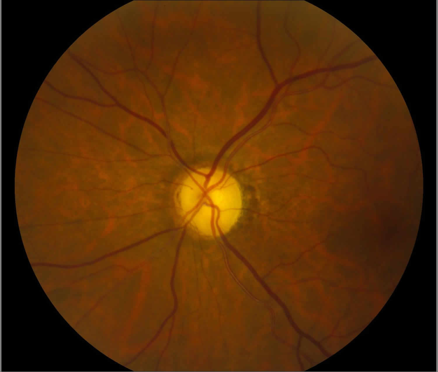 Optic Nerve Atrophy Causes Symptoms Diagnosis Treatment