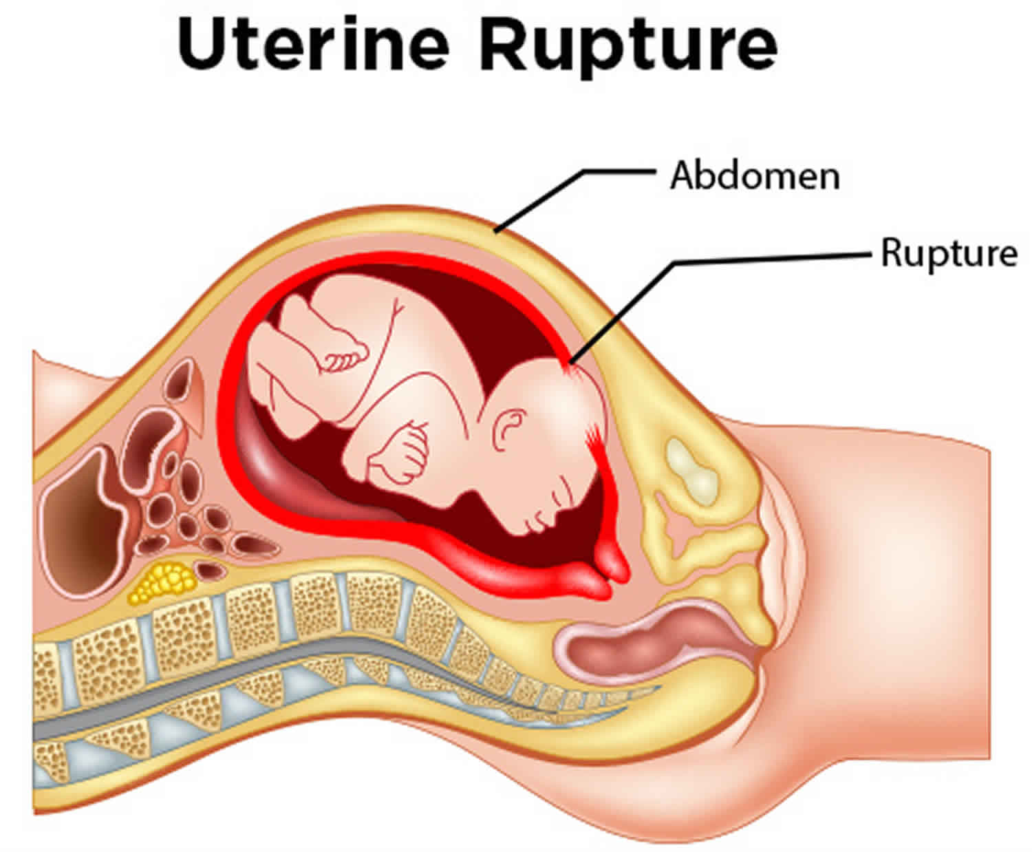 presentations of uterine rupture