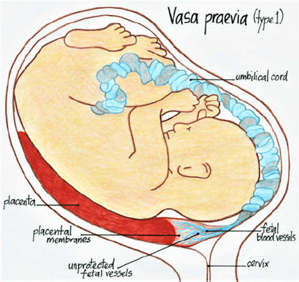 vasa-previa-definition-causes-symptoms-diagnosis-ultrasound