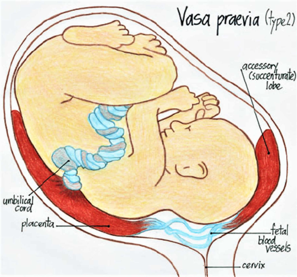 Vasa previa definition, causes, symptoms, diagnosis, ultrasound ...