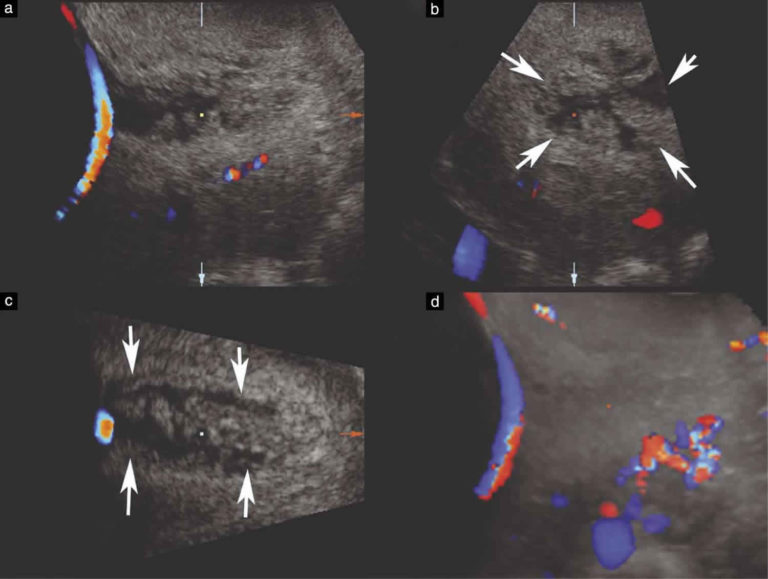 medical-ultrasound-placenta-previa