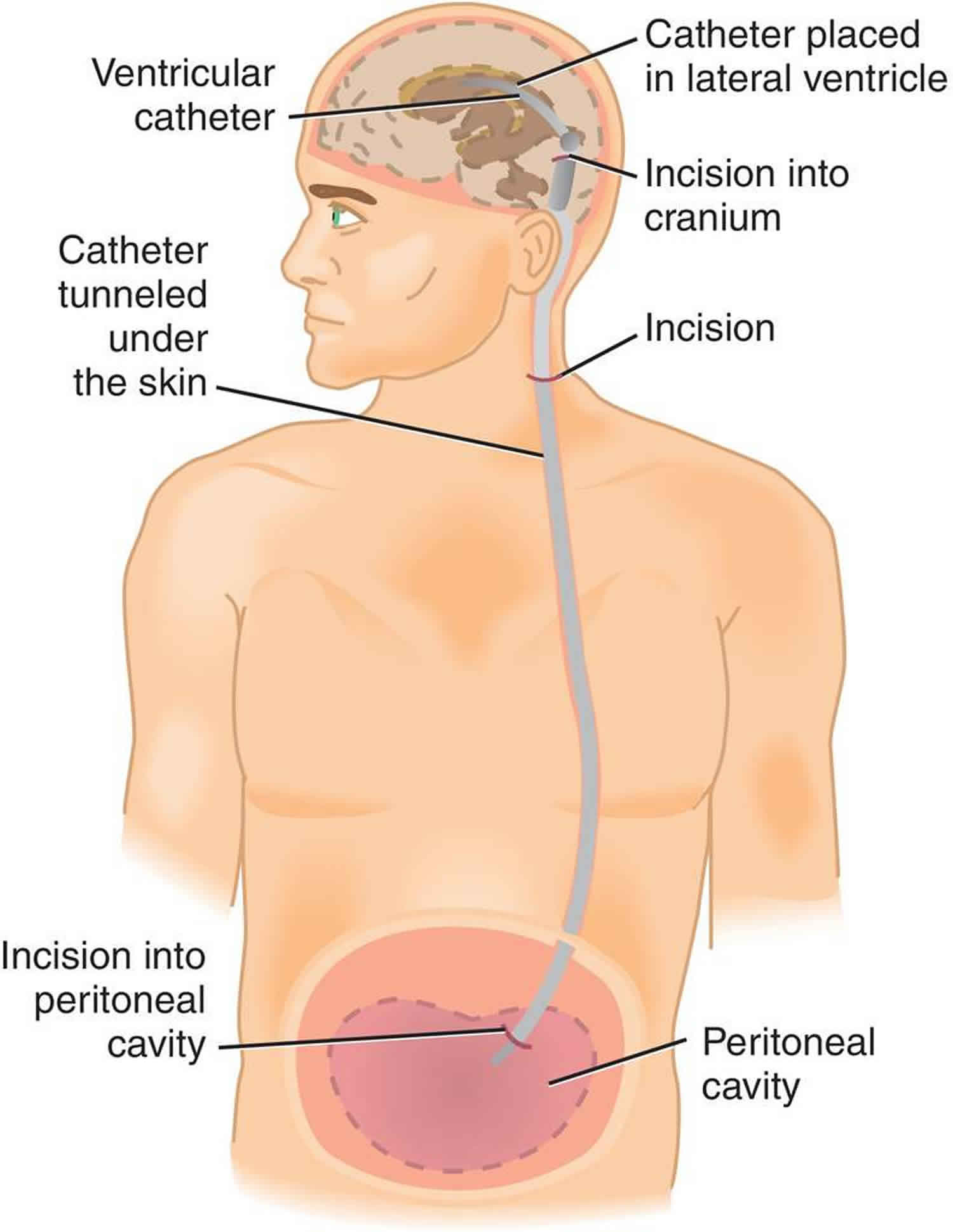 ventriculoperitoneal shunt complications