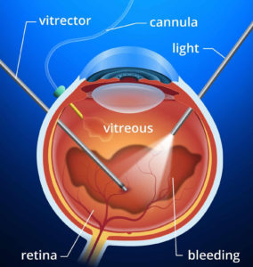 vitrectomy plana pars