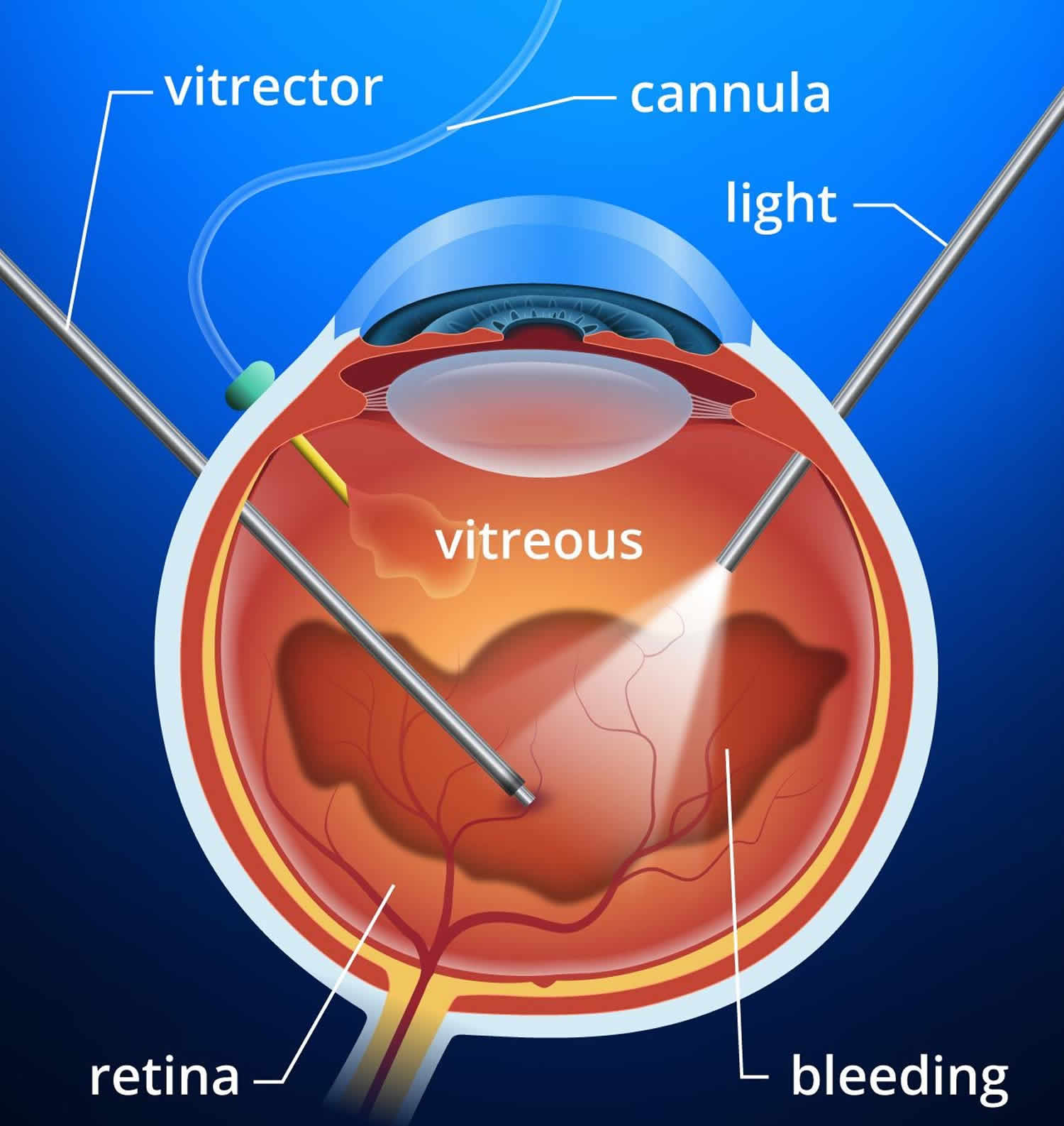 How To Sleep After Detached Retina Surgery : 4 Ways to Heal a Detached ...