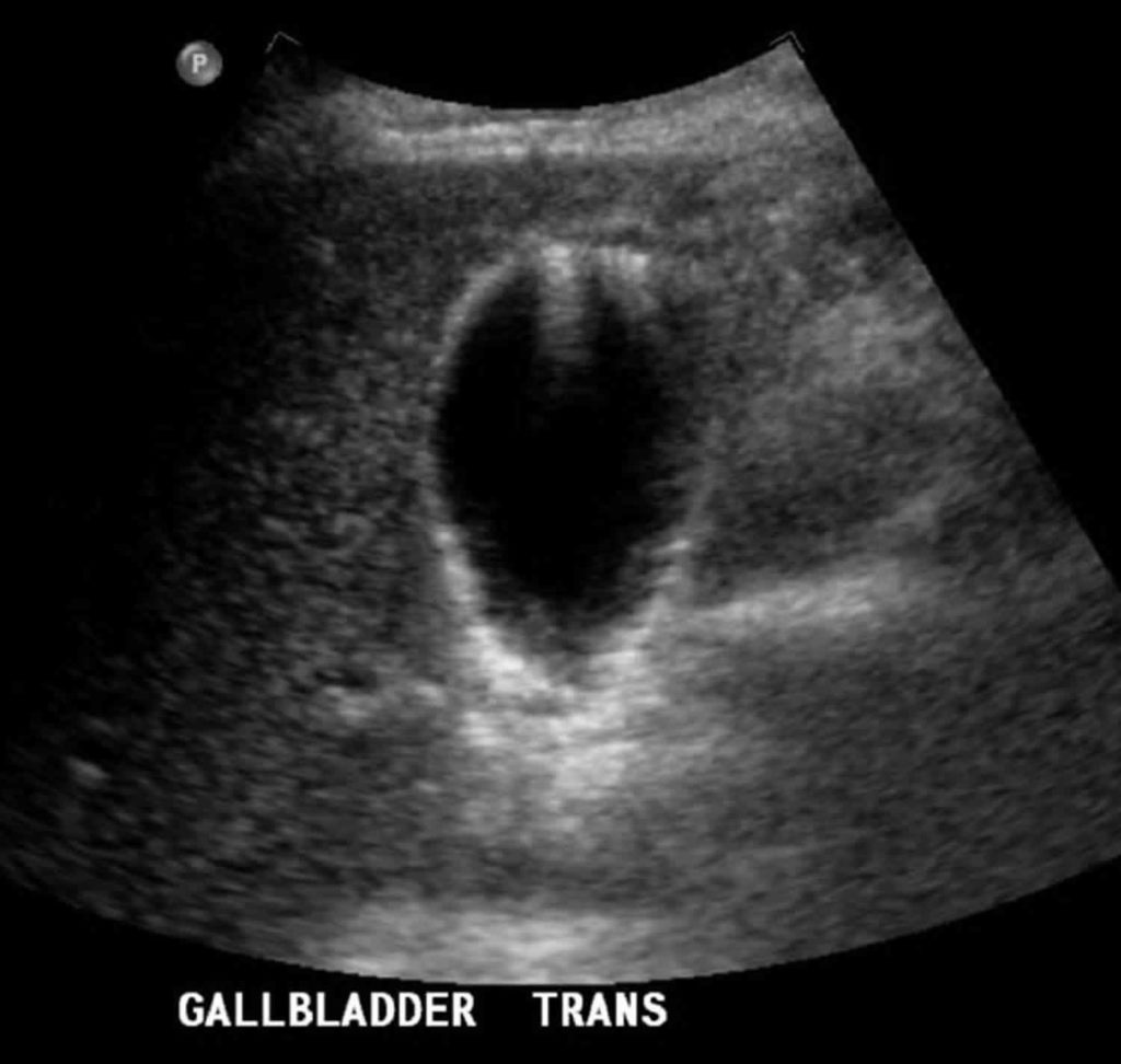 Gallbladder adenomyomatosis causes, symptoms, diagnosis, treatment ...